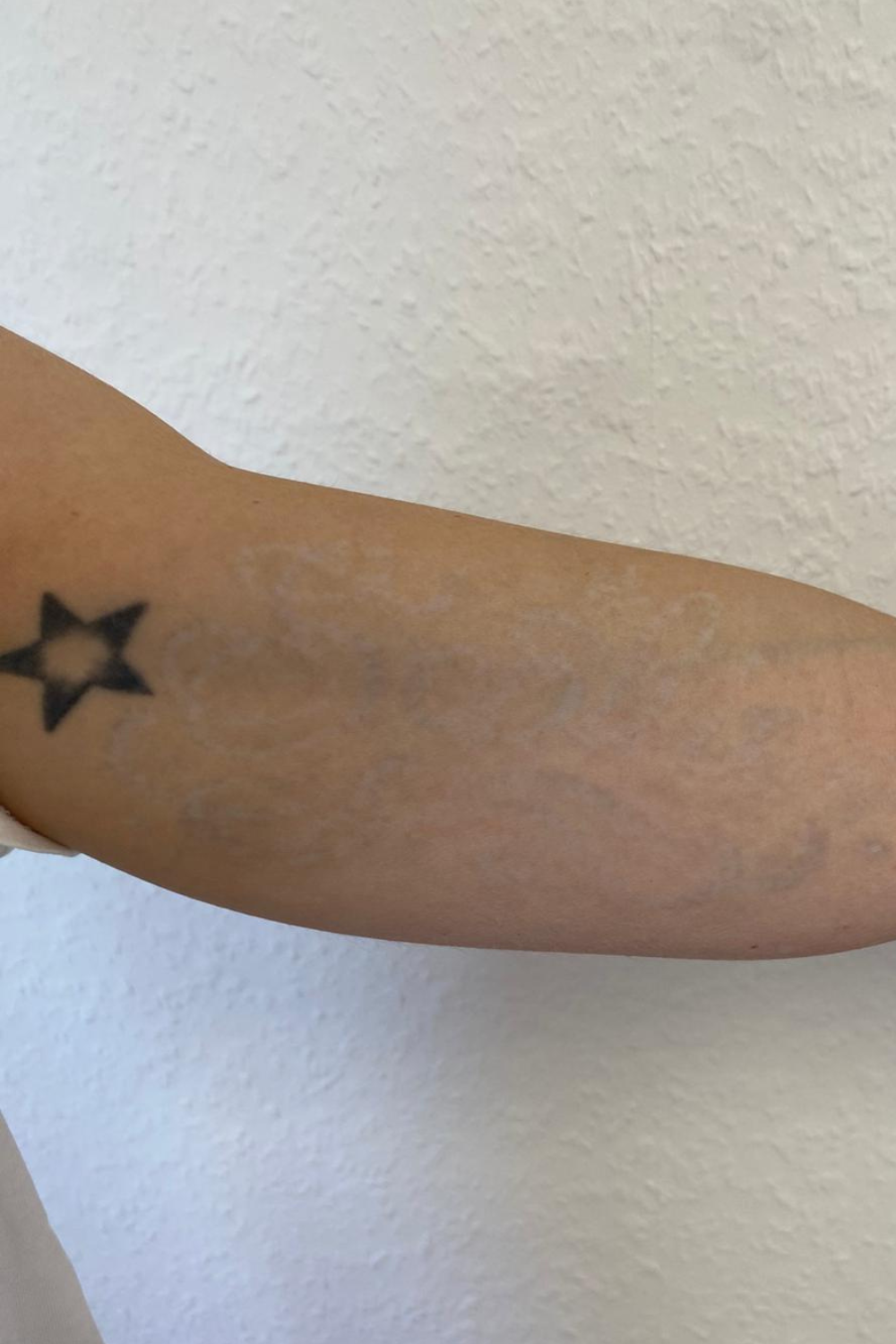 Tattooentfernung vorher nachher Pico Laser Aesthetiqua Frey