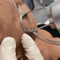 CO2 Laser Behandlung Mannheim Pforzheim Heidelberg Aesthetiqua