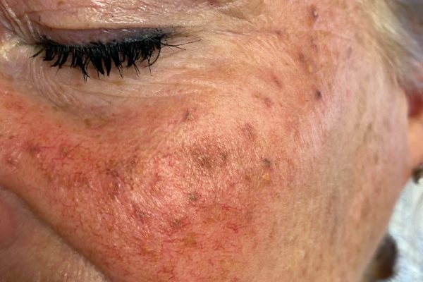 Entfernen-von-Permanentem-Make-Up-mit-einem-Laser-Aesthetiqua