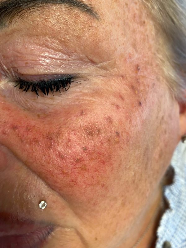 Entfernen-von-Permanentem-Make-Up-mit-einem-Laser-Aesthetiqua Entfernen-von-Permanentem-Make-Up-mit-einem-Laser-Aesthetiqua