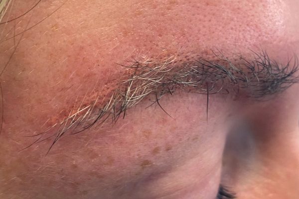 Ergebnis PMU Entfernen mit dem Laser Aesthetiqua