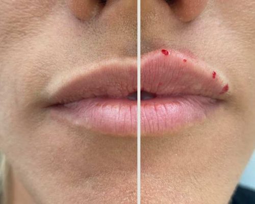 Lippen-auffüllen-Hyaluron-Dr-Frey-Aesthetiqua