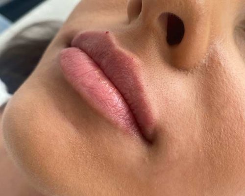 Lippen-aufspritzen-Hyaluron-Aesthetiqua-Dr-Frey