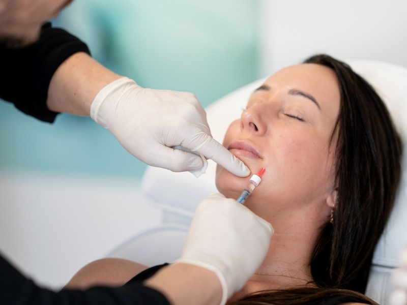 Nasolabialfalte behandeln mit Hyaluron Aesthetiqua