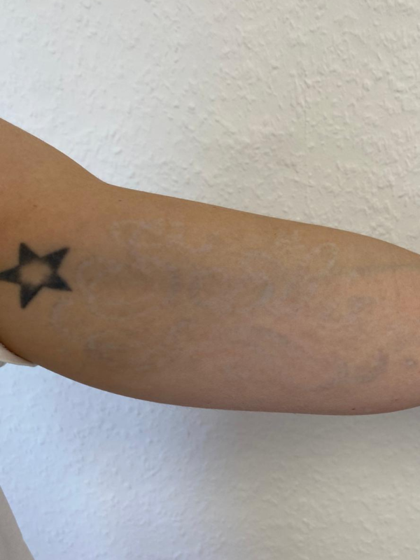Tattooentfernung vorher nachher Pico Laser Aesthetiqua Frey Tattooentfernung vorher nachher Pico Laser Aesthetiqua Frey