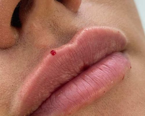 lippen-aufspritzen-heidelberg-aesthetiqua-hyaluron