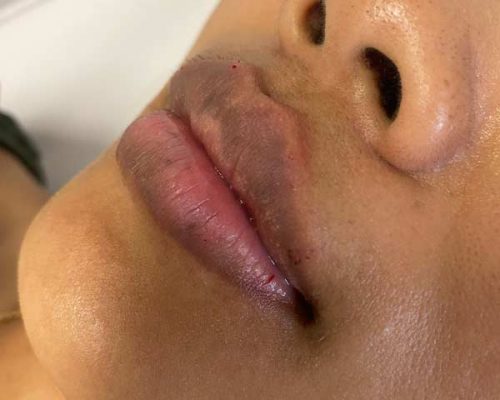 lippenunterspritzung-mannheim-Aesthetiqua-Hyaluron